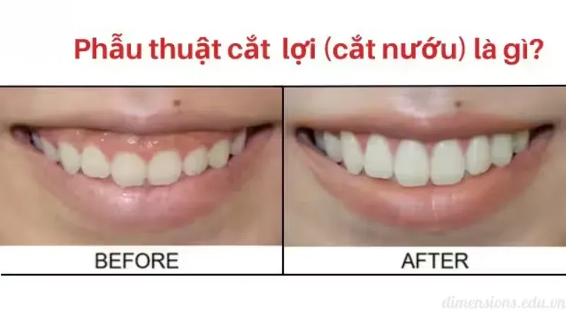 Cách khắc phục và cải thiện cười hở lợi