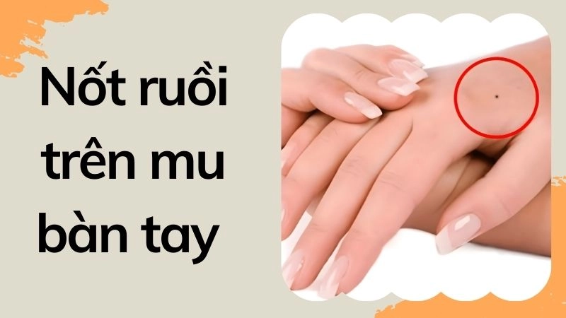 Nốt ruồi trên mu bàn tay - May mắn từ bên ngoài 